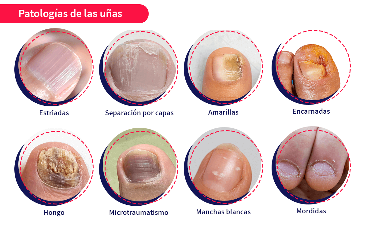 Útil Sabueso sacudir Anatomía y patologías de las uñas | Aprende.com